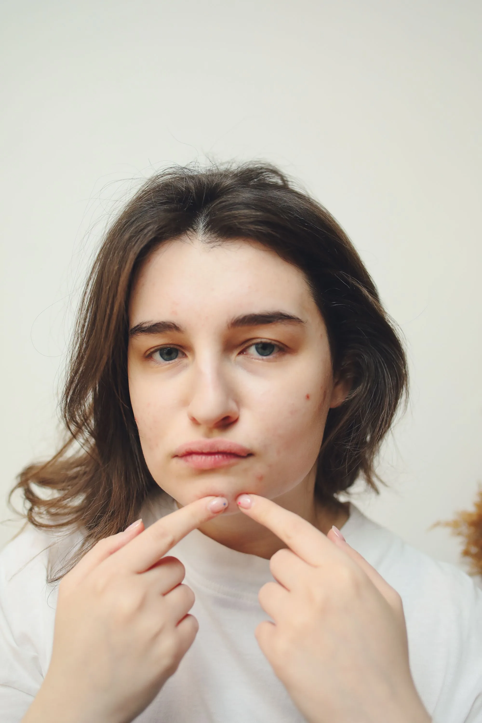 Causes of blackheads in adults and how to treat them